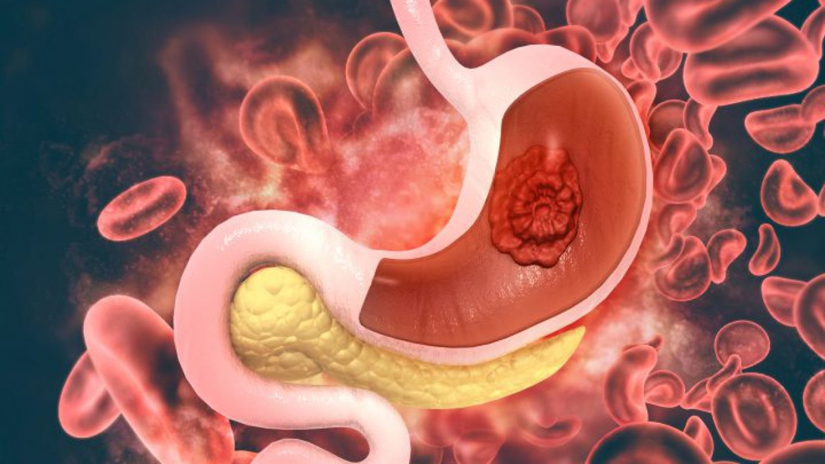 Gastrectomia totale e LAA interaortocavale laparoscopica per NET gastrico